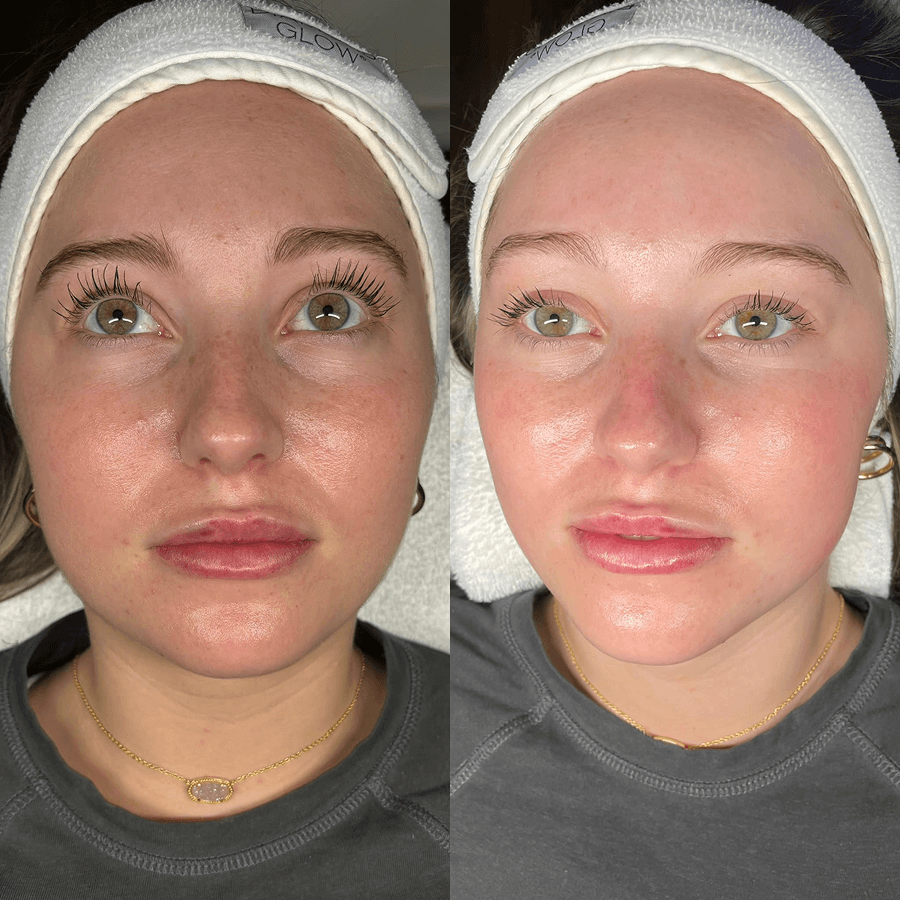 Lip Filler